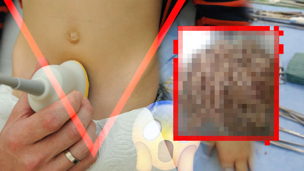Vierjähriger Junge hat Bauchweh – Ärzte machen Horror-Fund in seinem Bauch