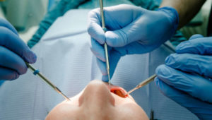 Todesdrama beim Zahnarzt! Wurzelbehandlung tötet jungen Mann