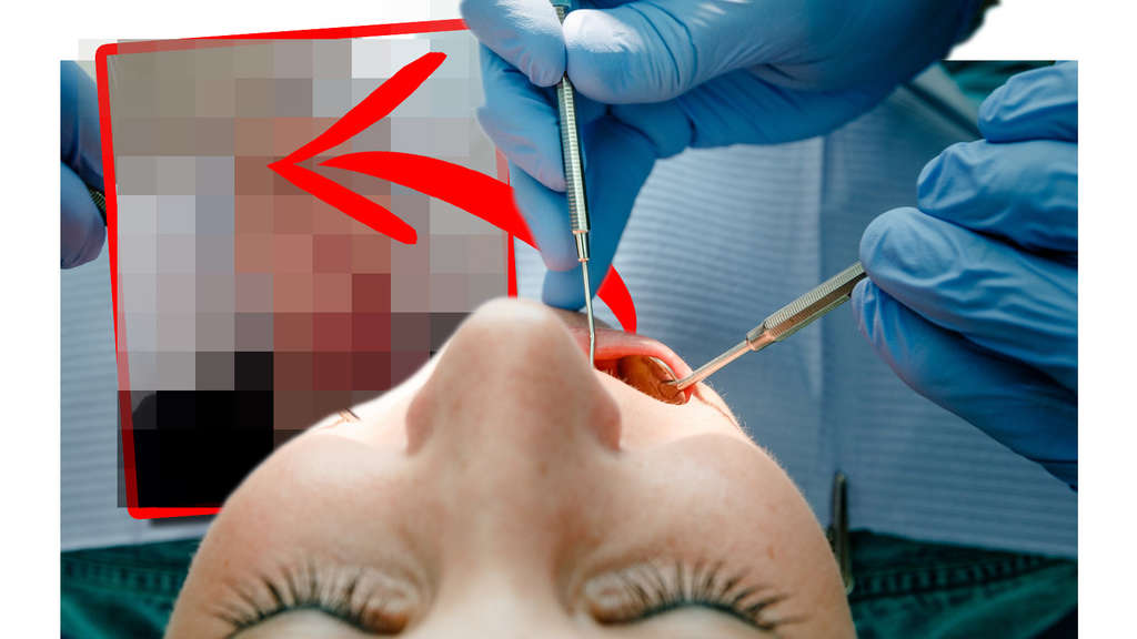 Zahnarzt-Desaster! Frau wacht nach Behandlung auf – die Hälfte des Gesichts ist weg